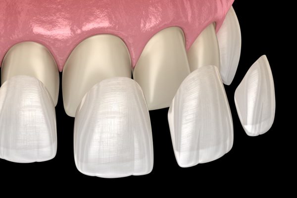 Miếng dán sứ được thiết kế với kiểu dáng, kích thước và màu sắc tương tự như răng thật