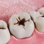 Răng hàm bị sâu và hậu quả không ngờ đối với sức khỏe