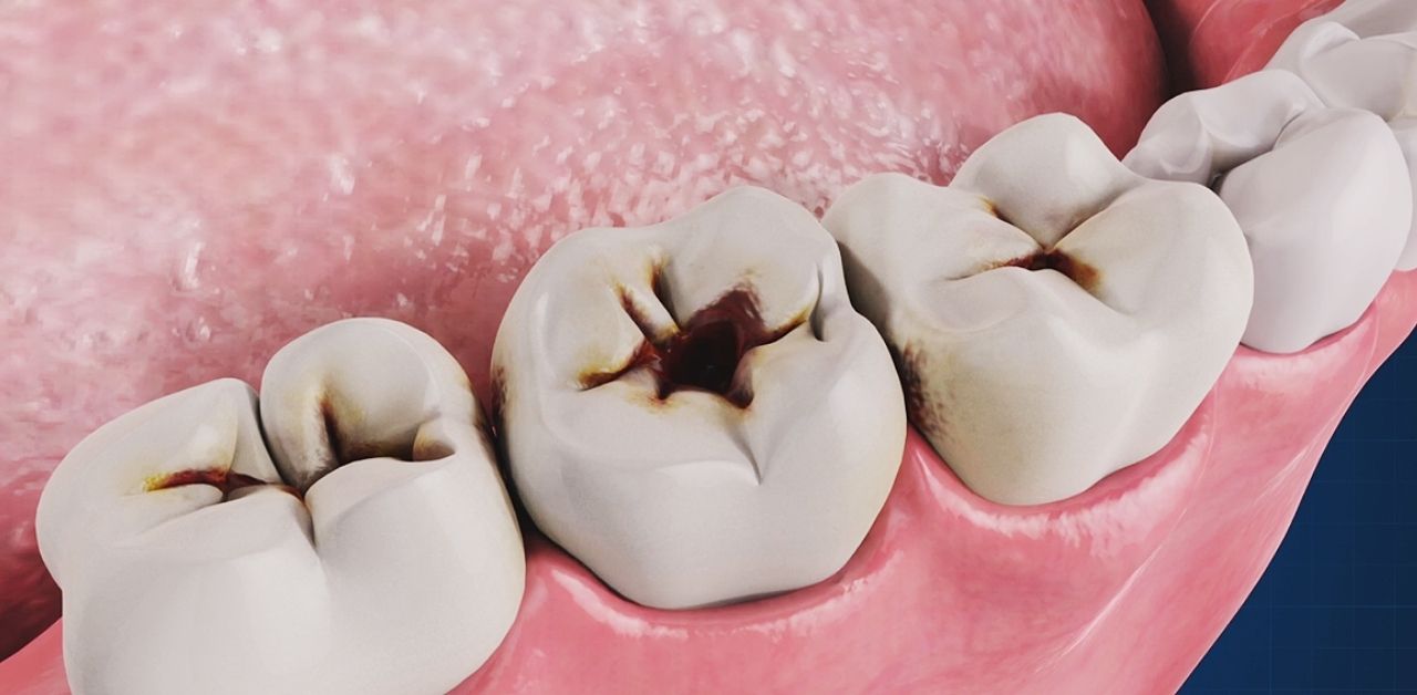 Nguyên nhân và cách điều trị răng bị sâu ăn mòn hết 