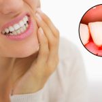 Răng sâu bị chảy máu nhiều phải làm sao? 