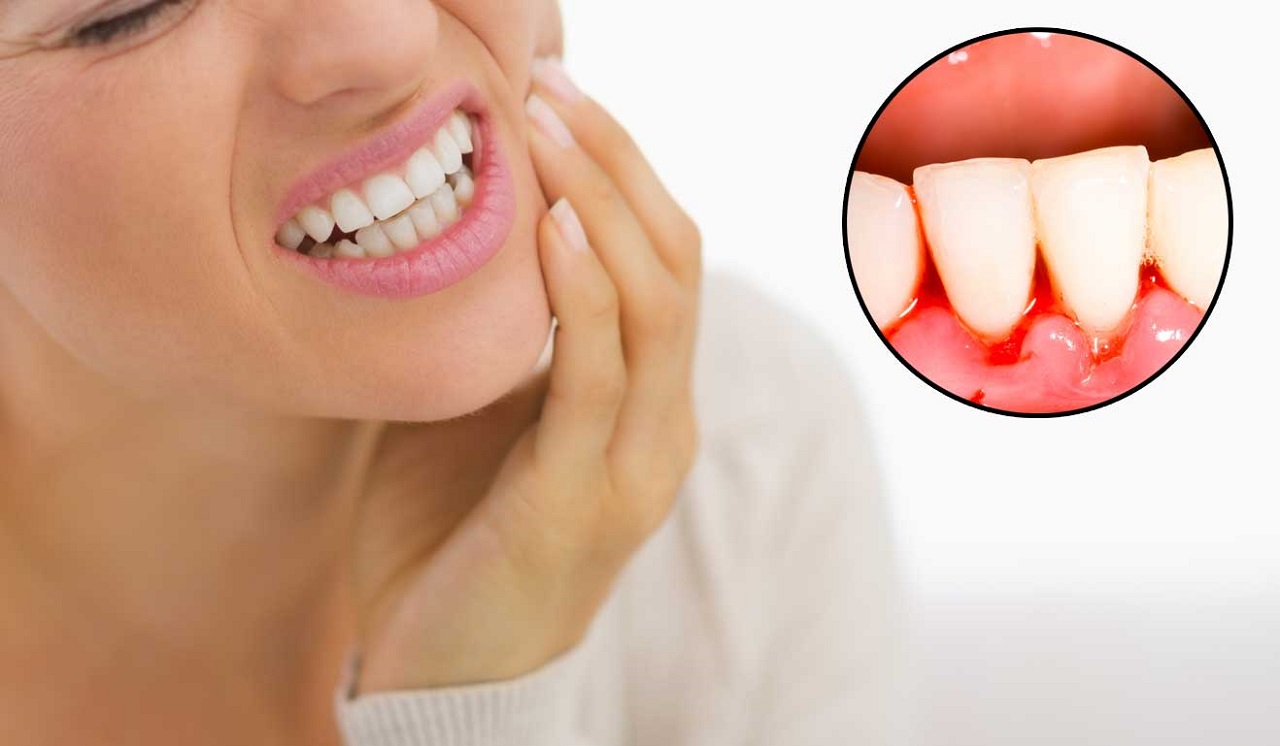 Có những biểu hiện nào cho thấy răng sâu bị chảy máu?
