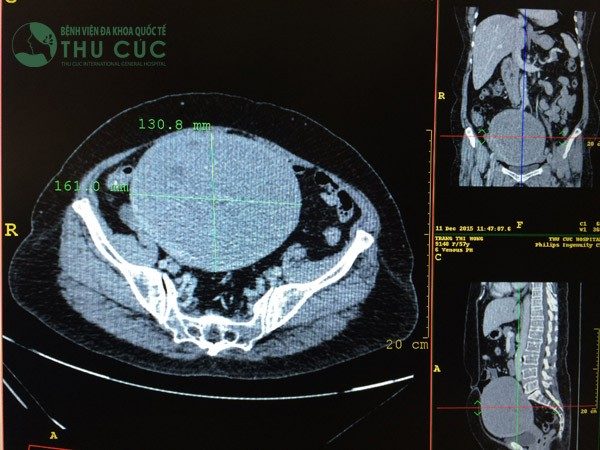 Chụp cắt lớp để chẩn đoán chính xác kích thước u xơ tử cung