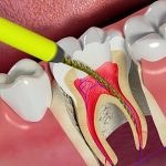 Sâu răng ăn vào tủy – Cẩn trọng tránh biến chứng nặng