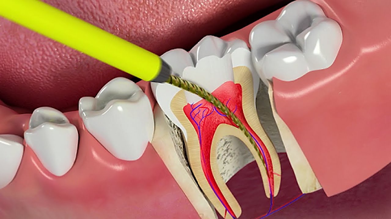 Những nguyên nhân nào dẫn đến sự phát triển của răng sâu đến tủy?
