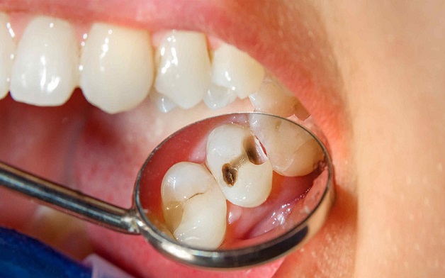 Sâu răng hiểu đơn giản là tình trạng phần mô cứng của răng bị tổn thương bởi quá trình hủy khoáng do vi khuẩn ở mảng bám gây ra