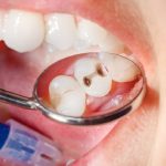 Lý giải nguyên nhân sâu răng dẫn đến hôi miệng 