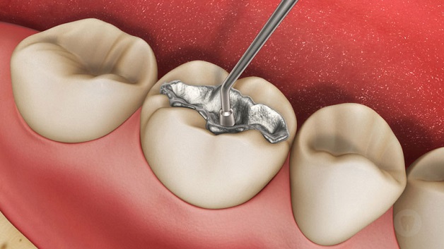 Hàn răng, hay còn có tên gọi khác trám răng là kỹ thuật sử dụng các vật liệu hàn răng để bù đắp khoảng trống và lấp đầy phần mô răng bị khuyết do sâu răng gây ra