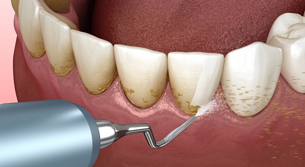 Triệu chứng viêm nha chu ở giai đoạn đầu có thể là hình thành vôi răng/cao răng