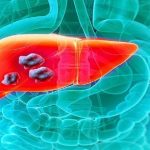 Phân biệt u gan và ung thư gan có khác nhau không?