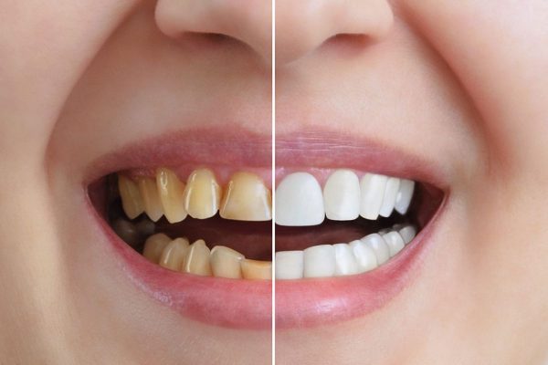 Phục hình thẩm mỹ và chức năng răng là ưu điểm của dán sứ veneer
