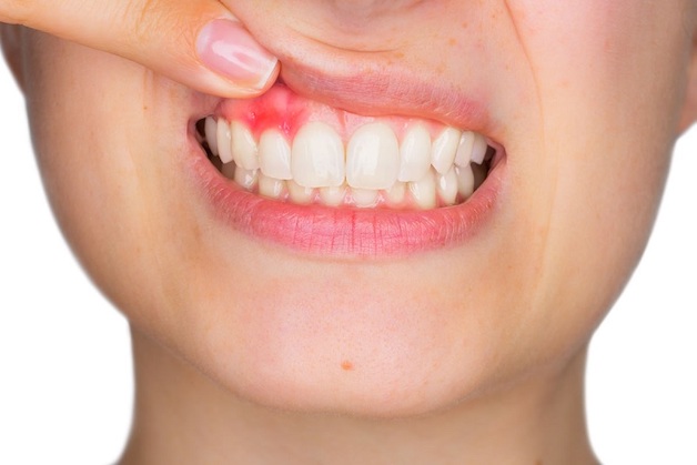 Viêm chân răng là bệnh lý phổ biến có thể xuất hiện ở mọi độ tuổi 