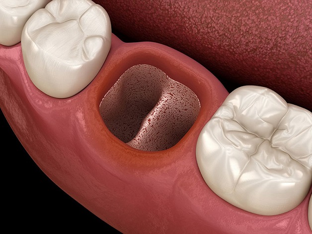 Viêm ổ răng khôn là một trong những biến chứng phổ biến sau viêm lợi