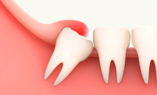 Viêm lợi trùm là tình trạng viêm ở xung quanh mô răng, thường xảy ra ở răng hàm thứ 3, hay còn gọi là răng số 8
