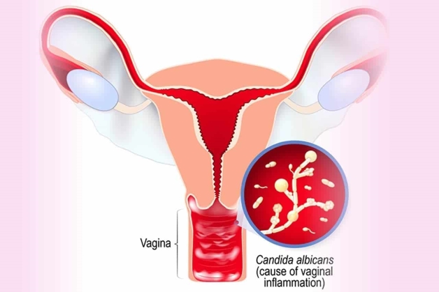 Phụ nữ có thể sẽ phải đối mặt với một số bệnh lý liên quan đến viêm phụ khoa sau sinh thường