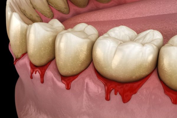 Răng mắc bệnh lý như viêm nha chu, sâu răng, viêm chân răng… chứa nhiều vi khuẩn có hại và gây ra tình trạng hôi miệng