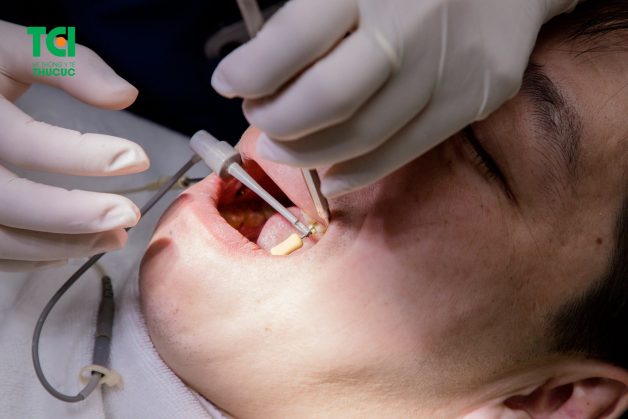Sâu răng vào tủy chỉ có thể được điều trị bằng phương pháp diệt tủy
