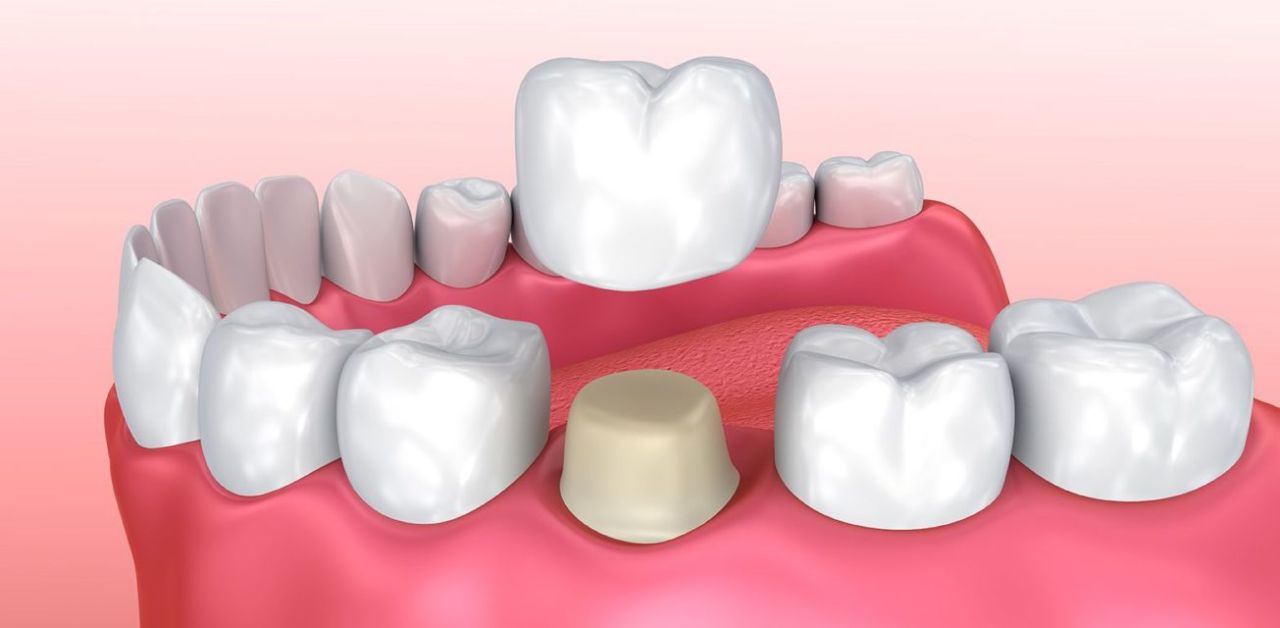 Có những nguy cơ hay vấn đề liên quan đến bọc răng sứ mà người dùng cần biết?
