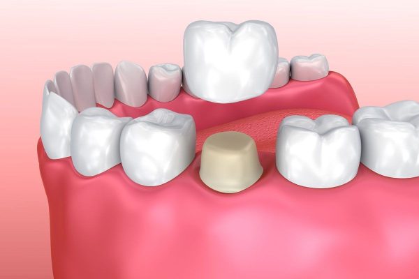Với phương pháp bọc răng sứ, răng thật được mài để tạo trụ đỡ mão sứ phía trên