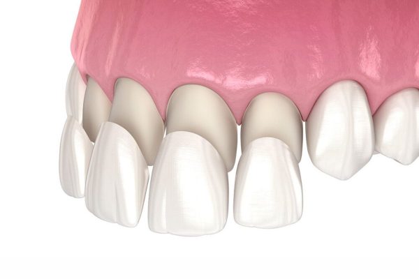 Mặt dán veneer được gắn lên răng thật bằng keo dán chuyên dụng để khắc phục một số khiếm khuyết của răng