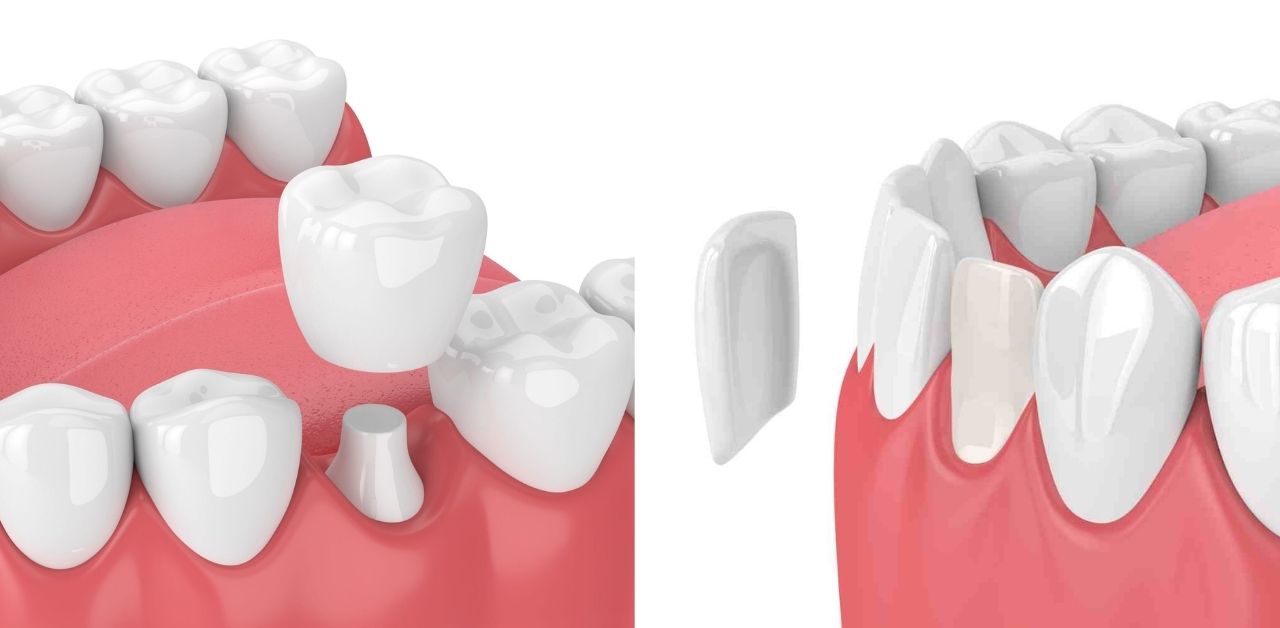 Răng sứ có độ bền cao không?
