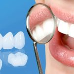 GIẢI ĐÁP: Bọc răng sứ xong có kiêng gì không? 