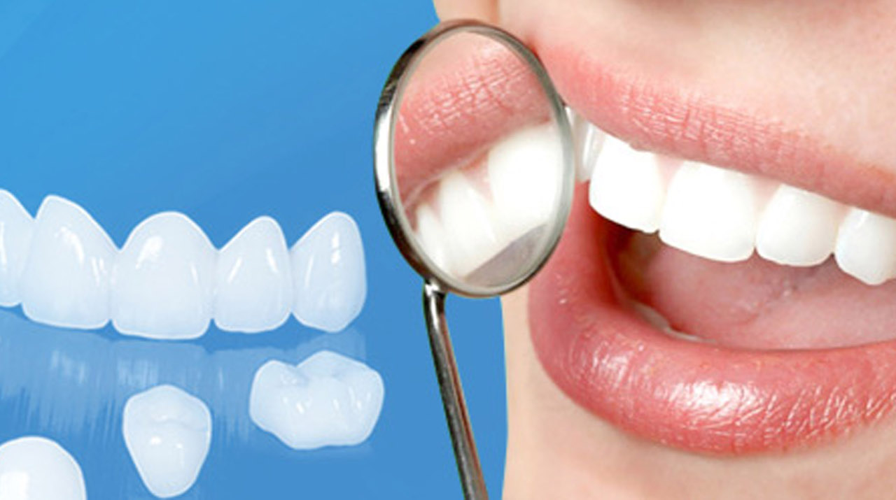 Những điều bạn cần biết về bọc răng sứ xong có kiêng gì không 