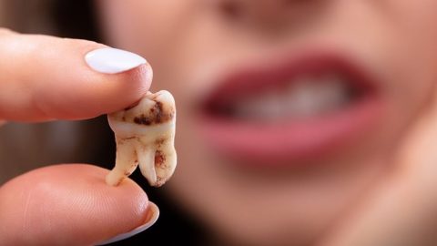 Tìm hiểu cách chữa sâu răng dứt điểm