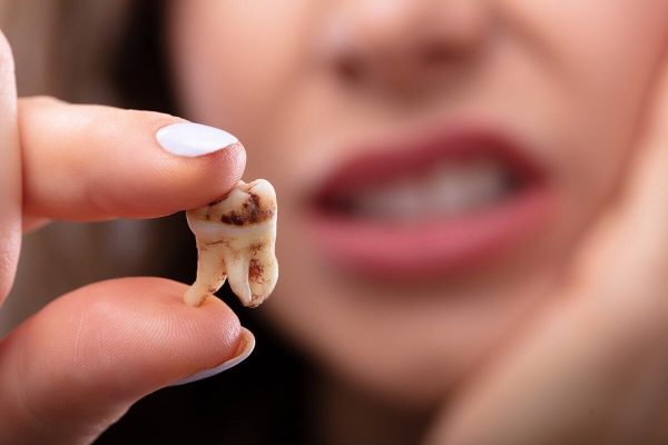 Sâu răng không tự khỏi, ảnh hưởng lớn tới sức khỏe và tâm lý của mọi người nên cần được điều trị kịp thời