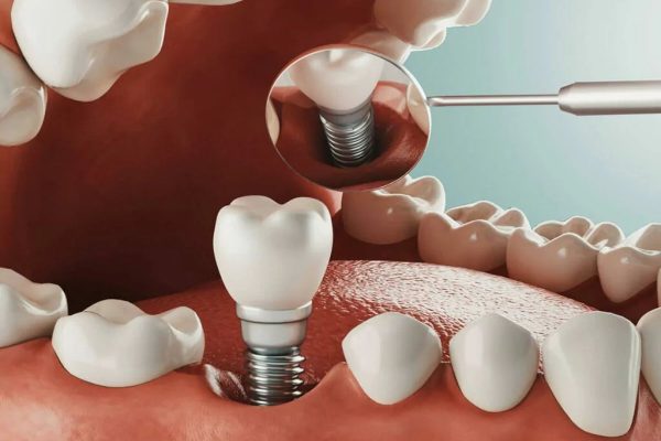 Thông qua việc cấy ghép Implant, mọi người có thể sở hữu hàm răng đảm bảo chức năng lẫn thẩm mỹ