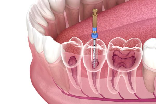 Tủy răng bị viêm nhiễm nặng nếu không loại bỏ kịp thời sẽ tiềm ẩn nhiều nguy cơ biến chứng