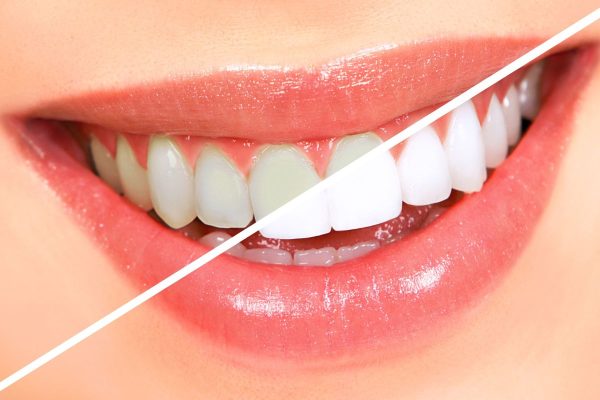 Chăm sóc răng miệng khoa học đóng vai trò quan trọng trong việc kéo dài tuổi thọ của răng sứ