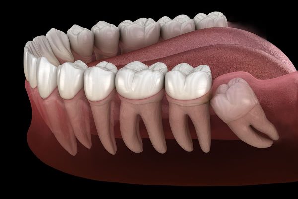 Răng khôn mọc ngầm, mọc lệch có thể dẫn tới tình trạng xiên xẹo các răng khác trên cung hàm