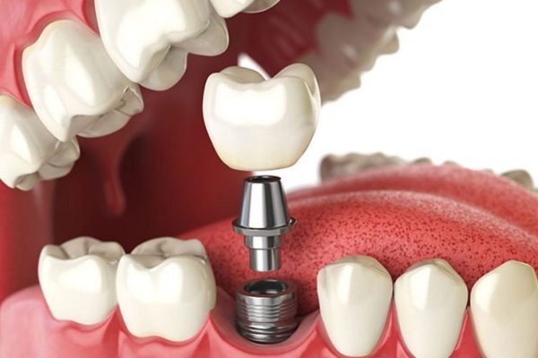 Cấy ghép implant khôi phục răng bị mất một cách hoàn hảo cả về chức năng lẫn thẩm mỹ