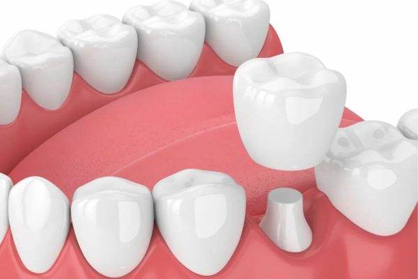 Bọc răng sứ là một kỹ thuật phục hình răng thông qua việc gắn mão sứ lên trên bề mặt răng thật