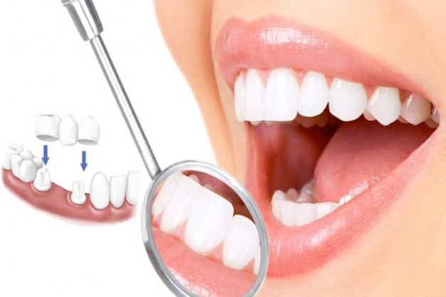 Bọc răng sứ có thể nói là một trong những kỹ thuật phổ biến trong nha khoa được nhiều khách hàng ưa chuộng