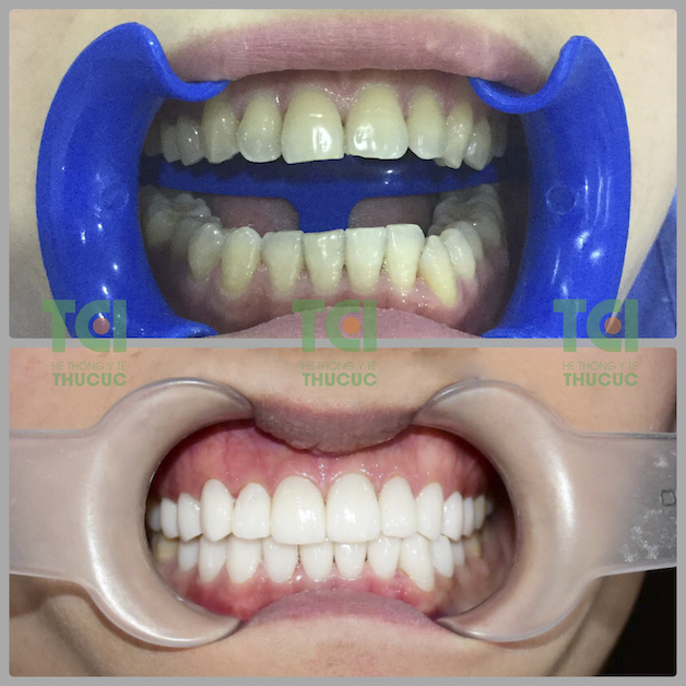 So sánh hình ảnh khách hàng trước và sau bọc răng sứ tại Thu Cúc TCI