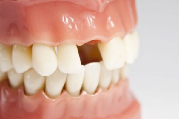 Mất răng ảnh hưởng lớn tới sức khỏe răng miệng và còn khiến cho hàm răng trở nên thiếu thẩm mỹ