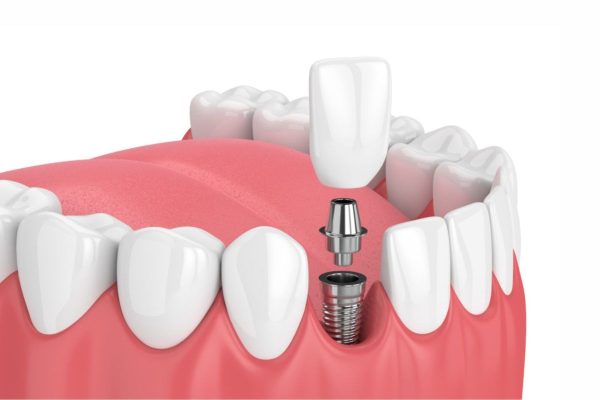 Phương pháp cấy ghép implant giúp phục hình răng bị mất thông qua việc cắm Implant để tạo trụ đỡ cầu răng sứ