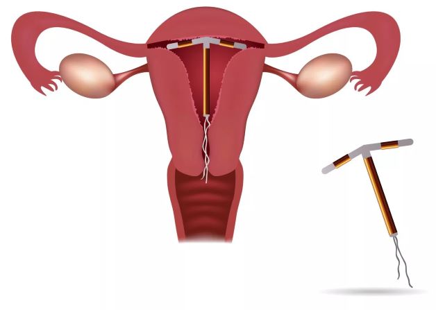 Vòng tránh thai âm đạo đầu tiên có thể sử dụng trong một năm  VnExpress  Sức khỏe