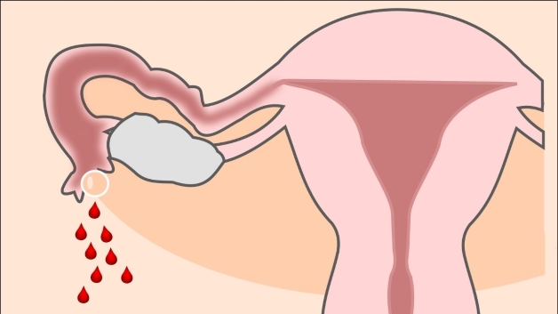 Dấu hiệu chửa ngoài tử cung - Chảy máu vùng âm đạo cũn là một trong những dấu hiệu cần phải chú ý bởi rất có thể đây là dấu hiệu của việc phụ nữ bị mang thai ngoài tử cung.