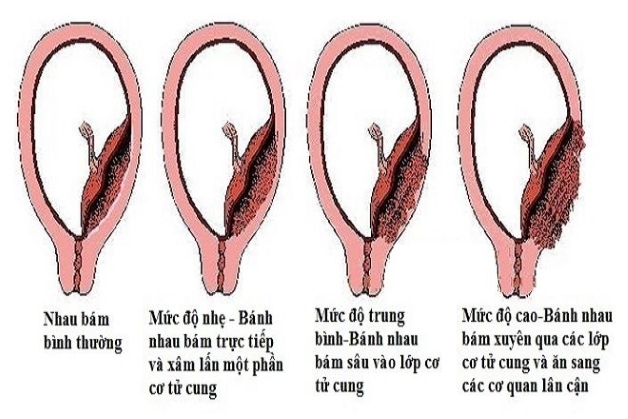 Đẻ mổ có bị sót rau không - Bất thường bánh nhau gây cản trở đến quá trình sổ thai, tống đẩy nhau thai ra ngoài, khiến các bánh nhau còn sót lại sau sinh.