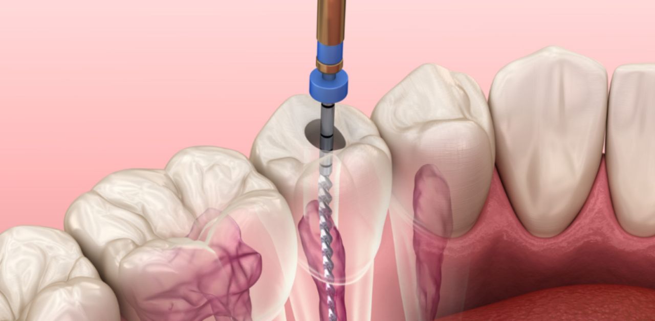 Có những nguyên tắc cần tuân thủ khi sử dụng thuốc điều trị tủy răng?