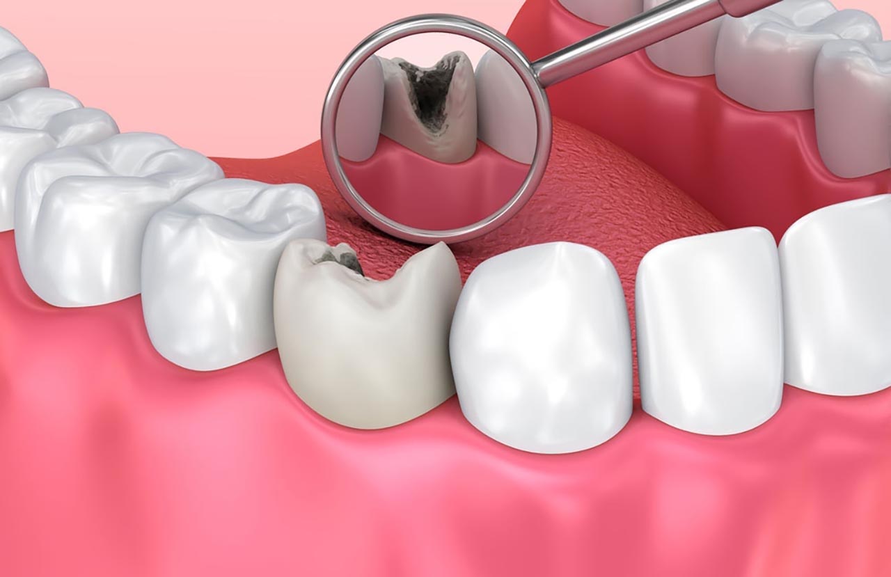 Làm thế nào để giảm đau và sưng sau khi nhổ răng sâu?
