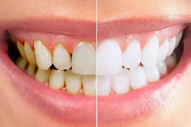 Lấy cao răng có hết hôi miệng không? Câu trả lời là lấy cao răng có thể khắc phục được hôi miệng đồng thời khiến hàm răng của bạn trở nên trắng sáng, đều màu hơn