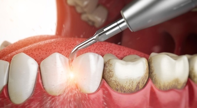 Cao răng là một trong những thủ phạm hàng đầu dẫn đến hôi miệng