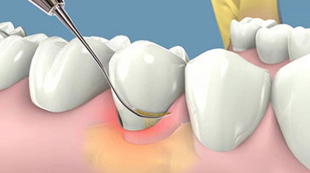 Cao răng (hay còn gọi vôi răng) là những mảng bám cứng nằm ở trên hoặc dưới đường viền nướu ở bề mặt răng.