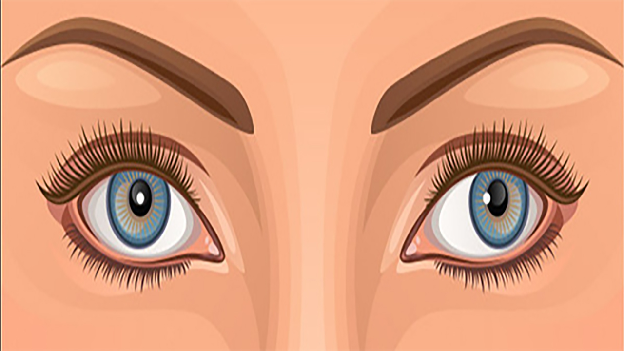  Mắt lé kim là như thế nào ? Cách giảm ngứa mắt hiệu quả và tự nhiên