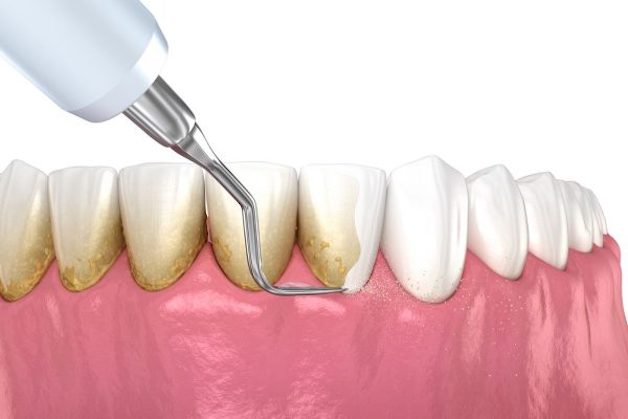 Lấy cao răng là biện pháp quen thuộc với rất nhiều khách hàng 
