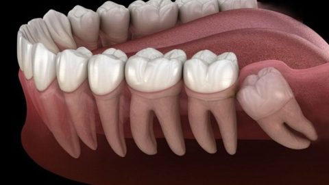 Nhổ răng 8 mọc ngầm và những điều bạn cần biết