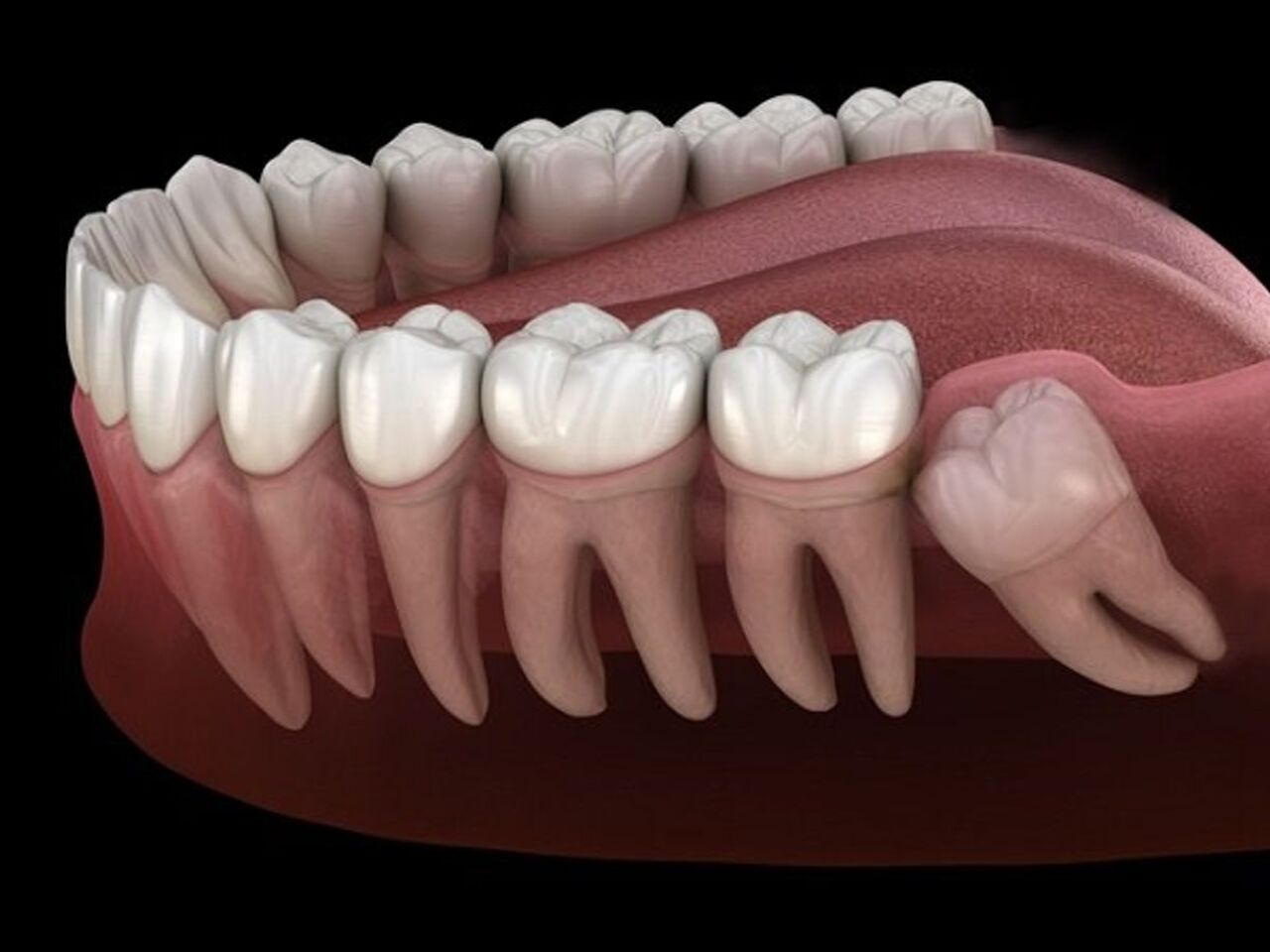 Quá trình mọc răng số 8 mọc ngầm kéo dài bao lâu?
